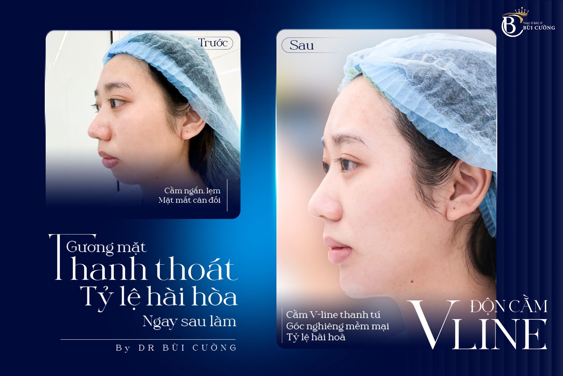 Độn gương mặt: Giải pháp tạo hình khuôn mặt cân đối với độn thái dương, độn hố lê và độn cằm