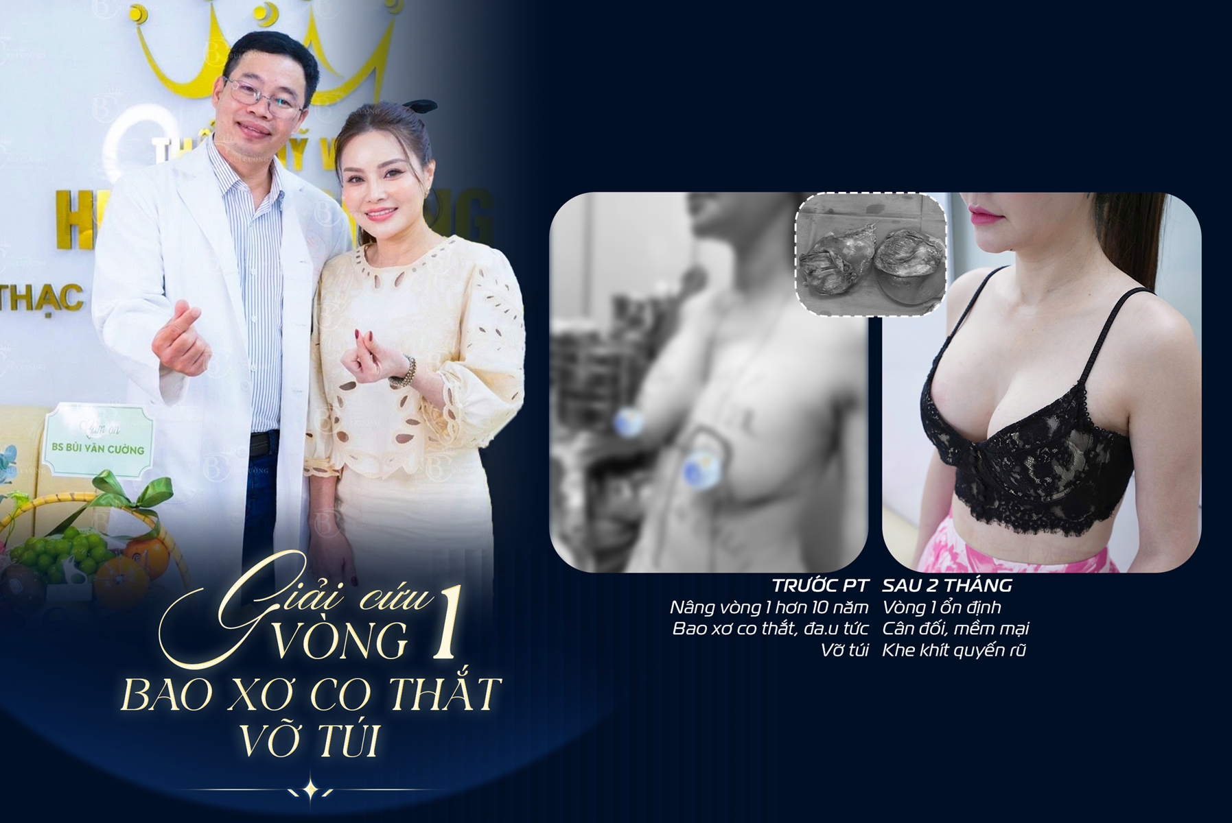 Vỡ túi ngực kèm co thắt bao xơ: Hành trình lấy lại vòng 1 khoẻ đẹp của chị Nguyễn Phương Lan