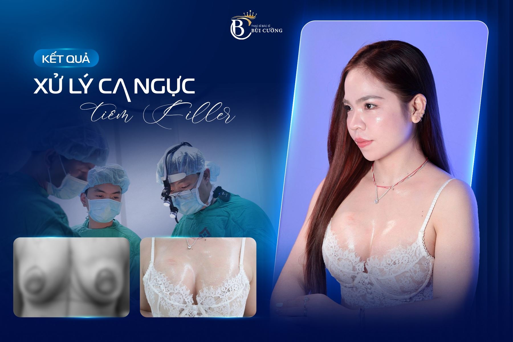  Xử lý filler & nâng ngực trong 1 lần phẫu thuật - Case thực tế từ Ths.BS Bùi Cường