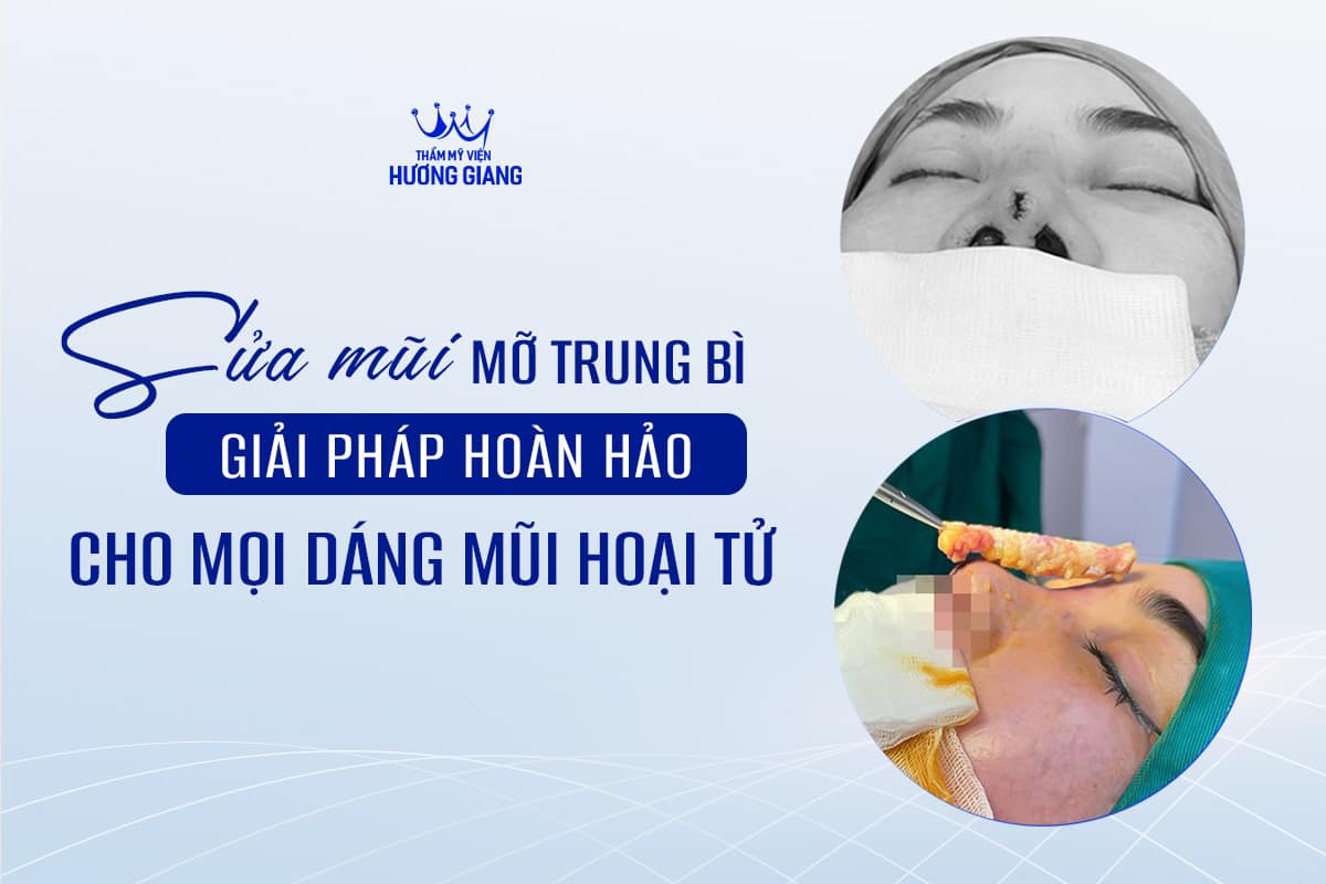 Sửa Mũi Mỡ Trung Bì - Giải Pháp Hoàn Hảo Cho Mọi Dáng Mũi Hoại Tử