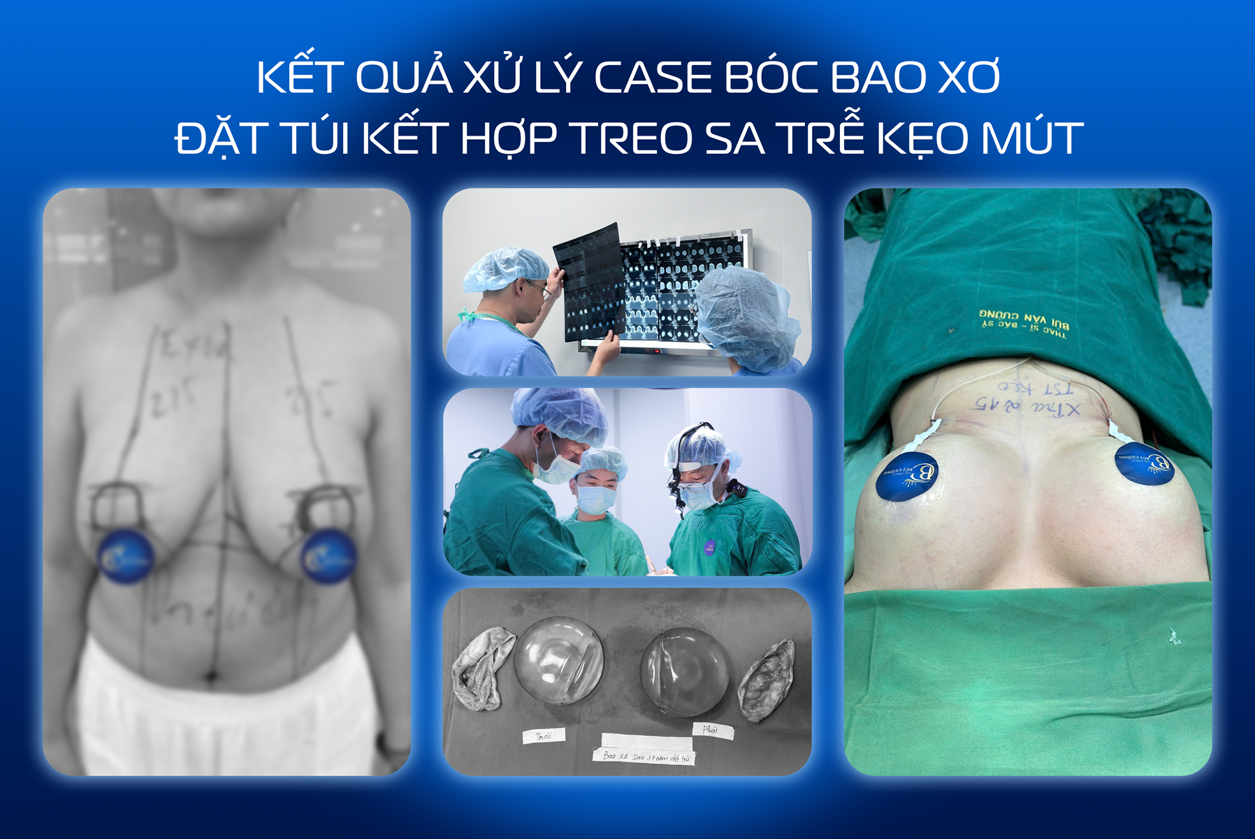 Ths.BS Bùi Văn Cường: Đừng chủ quan với những dấu hiệu bao xơ sau nâng ngực