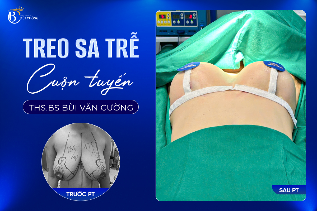 Treo sa trễ - Bảo tồn tối đa cảm giác và chức năng 