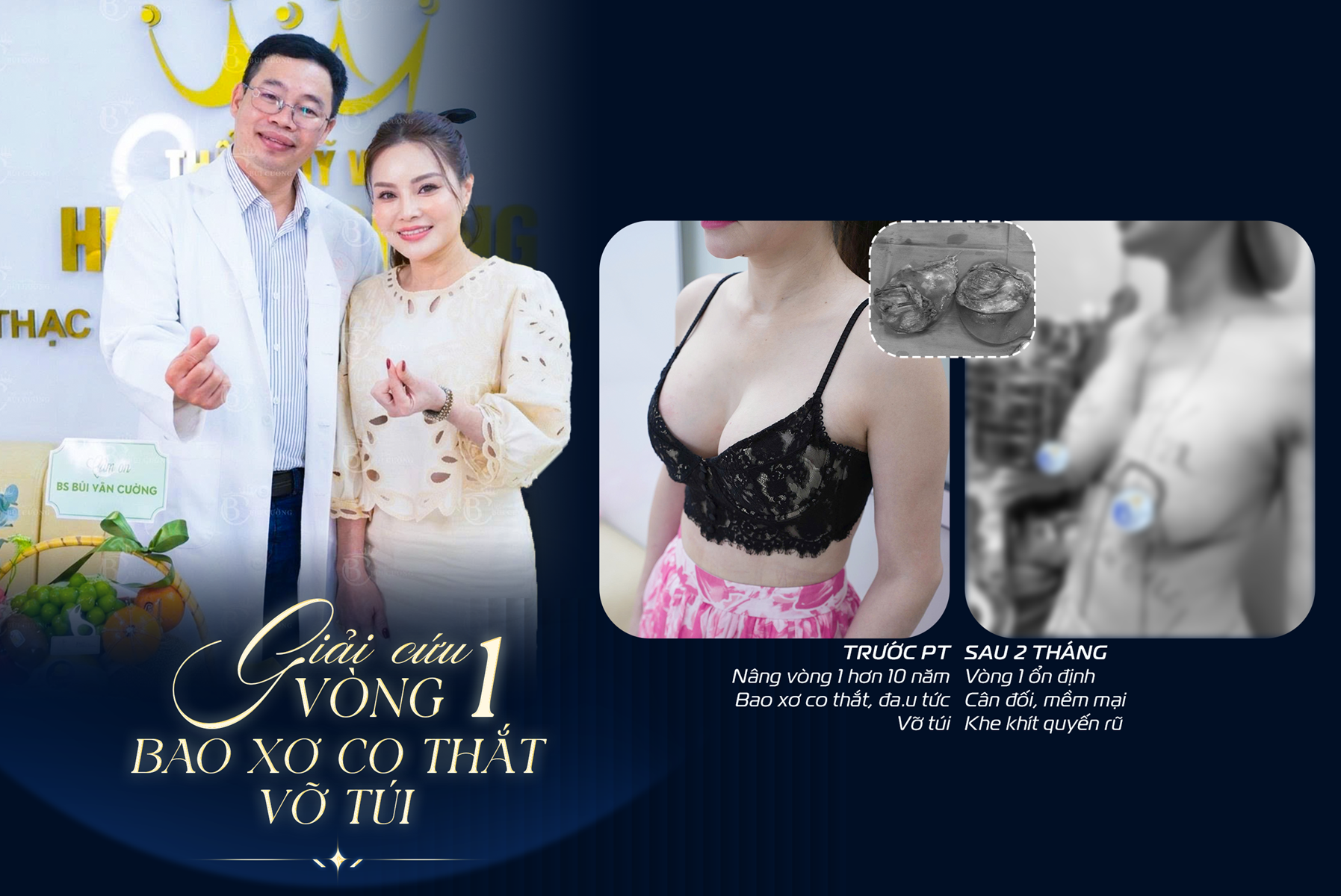 Vỡ túi ngực kèm co thắt bao xơ: Hành trình lấy lại vòng 1 khoẻ đẹp của chị Nguyễn Phương Lan