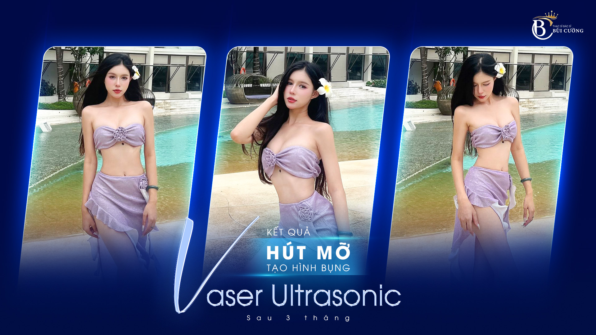 Hút mỡ tạo hình bụng Vaser Ultrasonic bao lâu hồi phục? Lộ trình chi tiết A - Z
