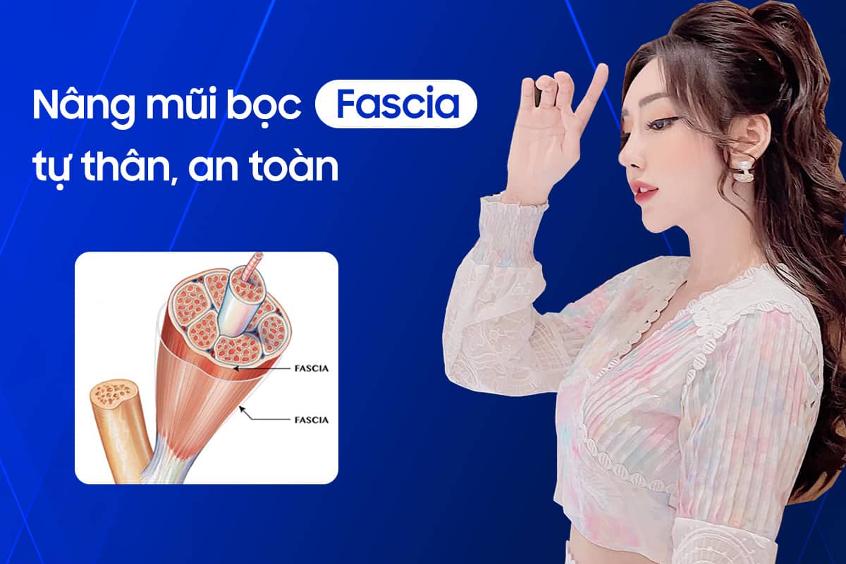 Nang mui boc fascia là gì?