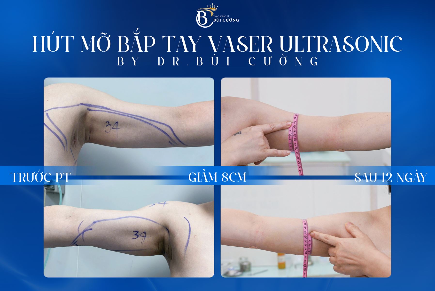 Hút mỡ bắp tay là gì? Những điều cần biết trước khi thực hiện