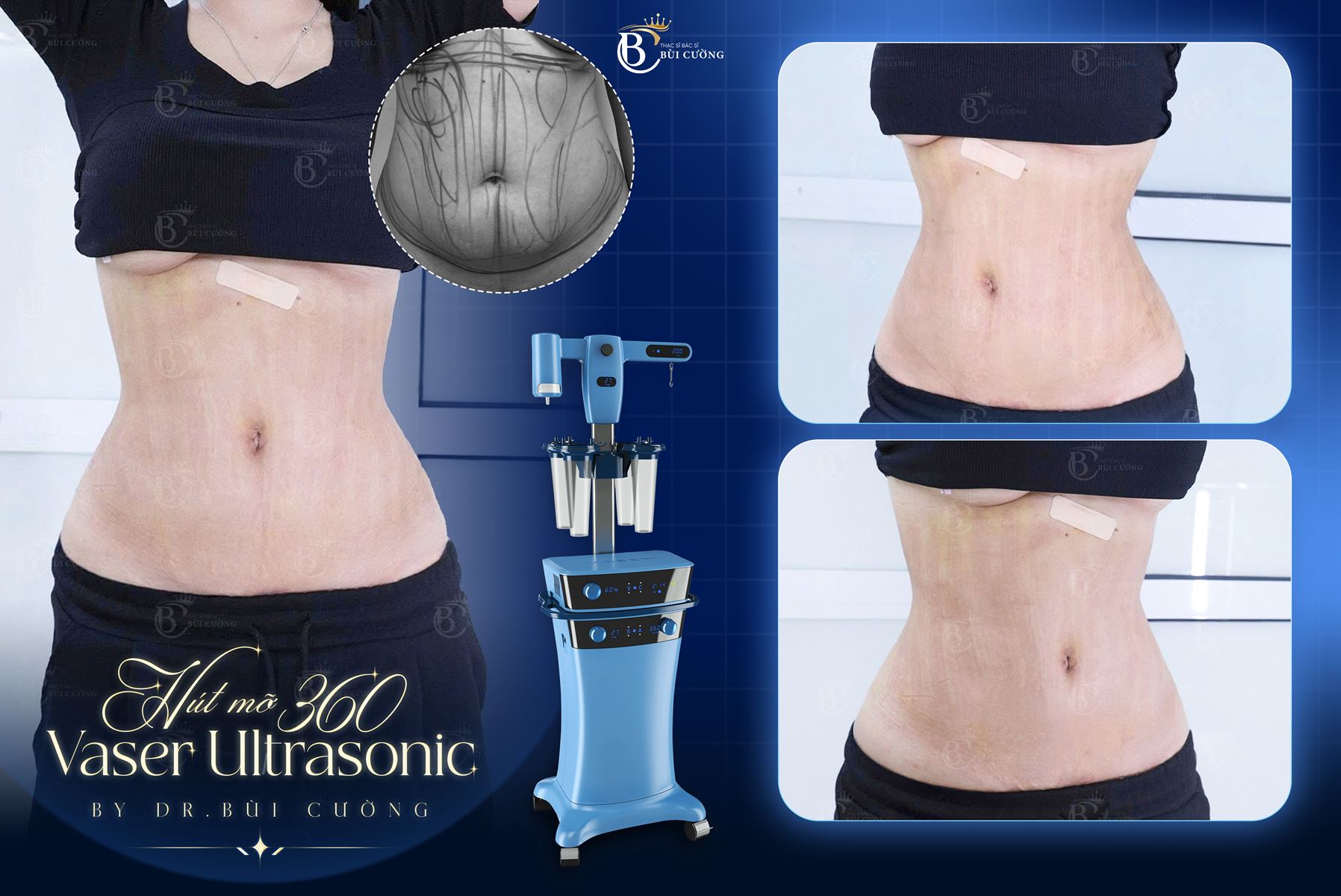 Hút mỡ bụng có để lại sẹo không? Bác sĩ giải đáp