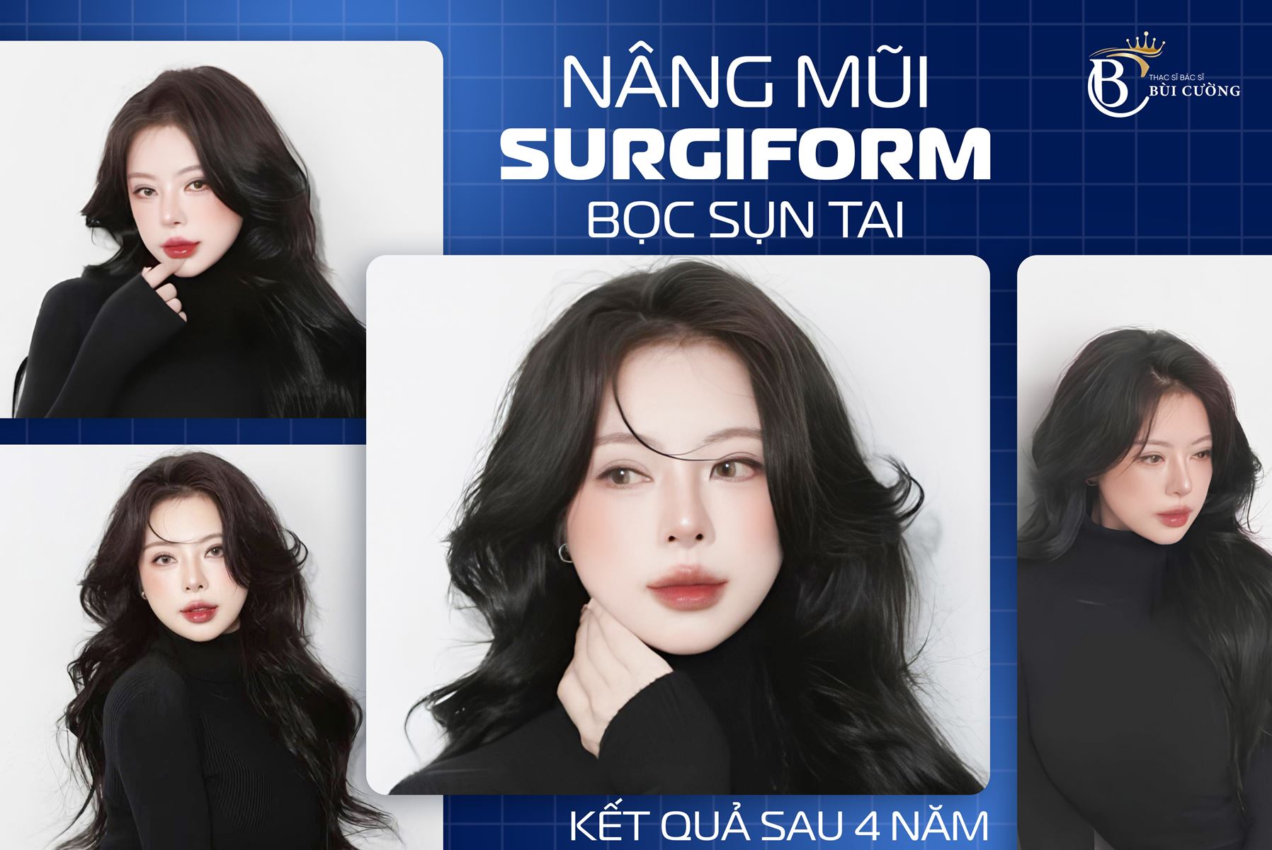 Nâng mũi sụn tai có tốt không? Ưu nhược điểm và những điều cần biết