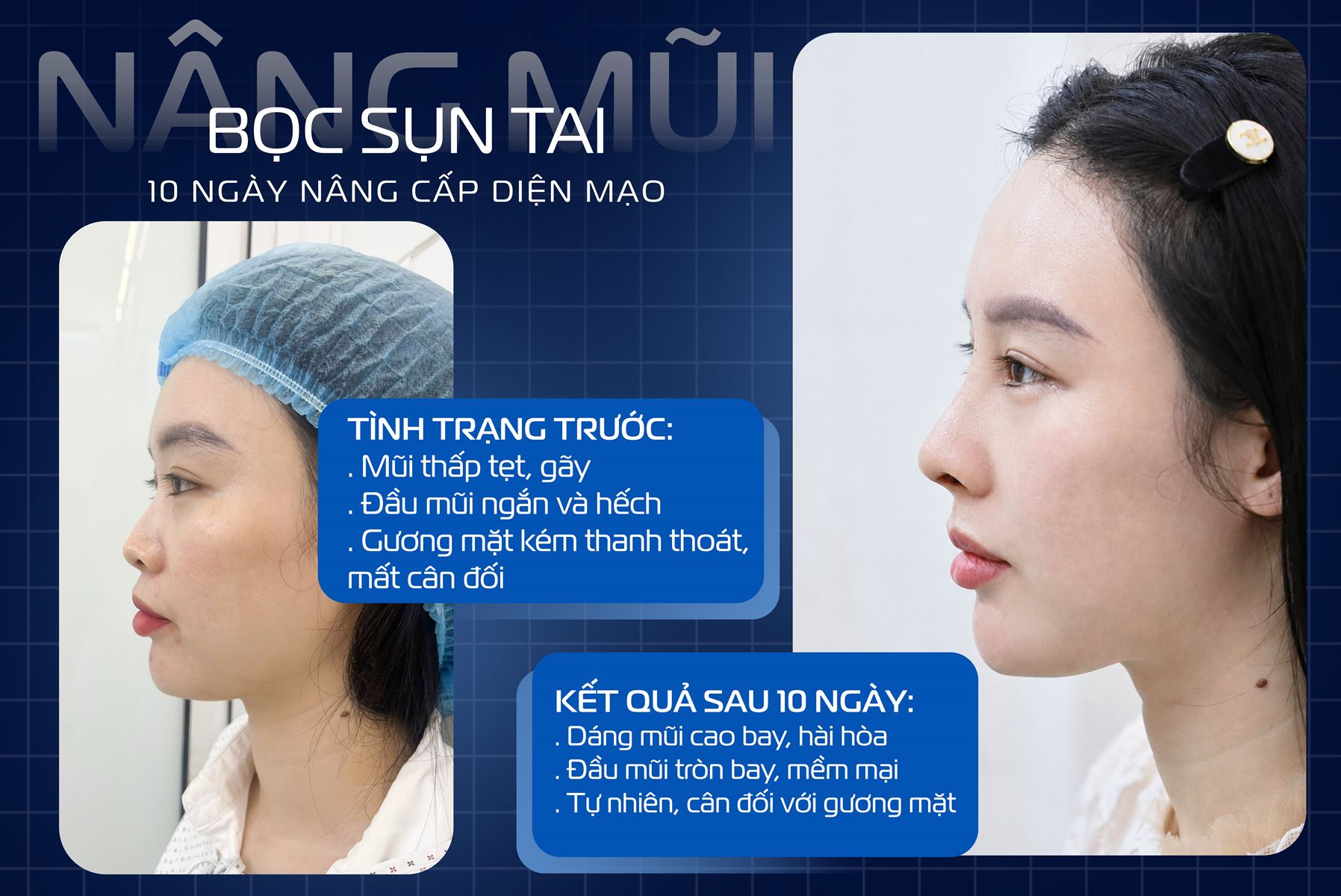 Sụn tai nâng mũi là gì? Vì sao được sử dụng trong phẫu thuật nâng mũi?