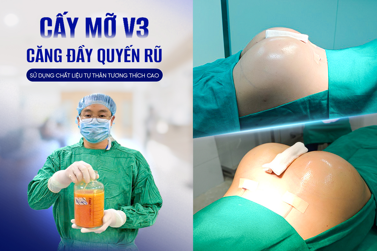 Cấy mỡ tự thân có bị tiêu không? Giải đáp từ Ths.BS Bùi Văn Cường