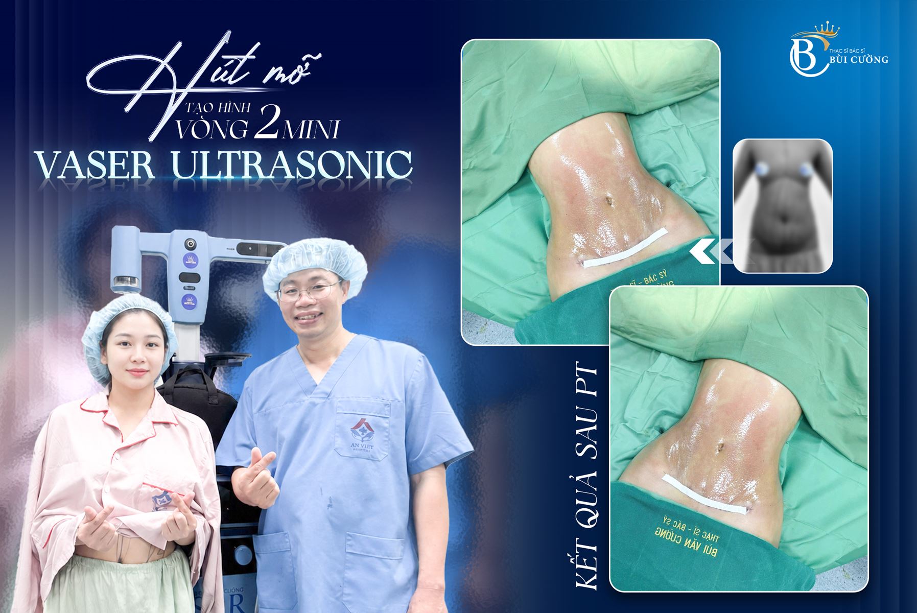 Tiêu chuẩn đánh giá ca hút mỡ đẹp: 4 yếu tố quyết định kết quả thẩm mỹ hoàn hảo