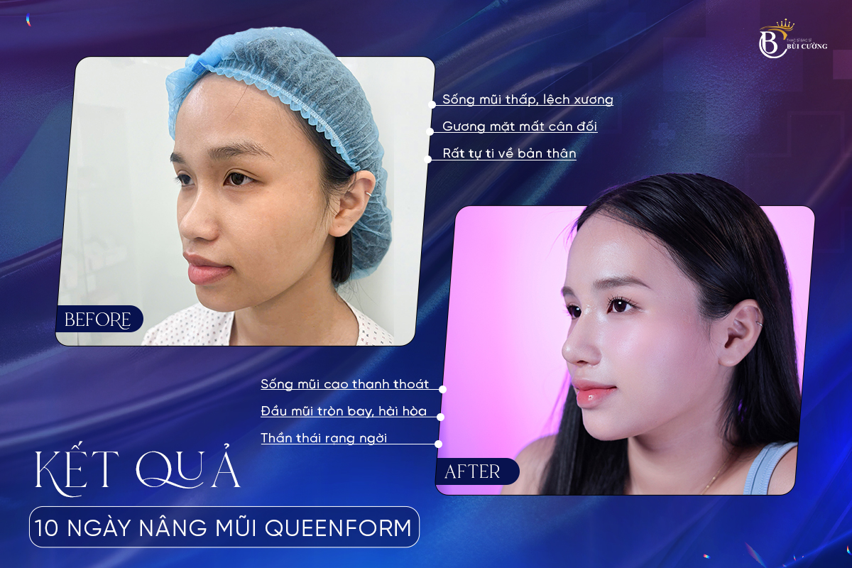 5 yếu tố quyết định nâng mũi thành công và an toàn