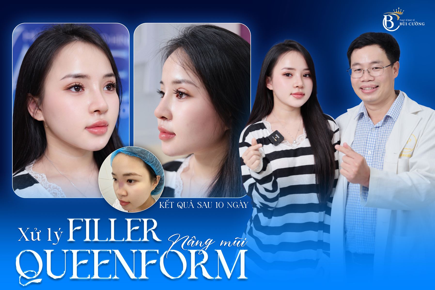 Sửa mũi hỏng là gì? Những trường hợp nào cần tái cấu trúc mũi?