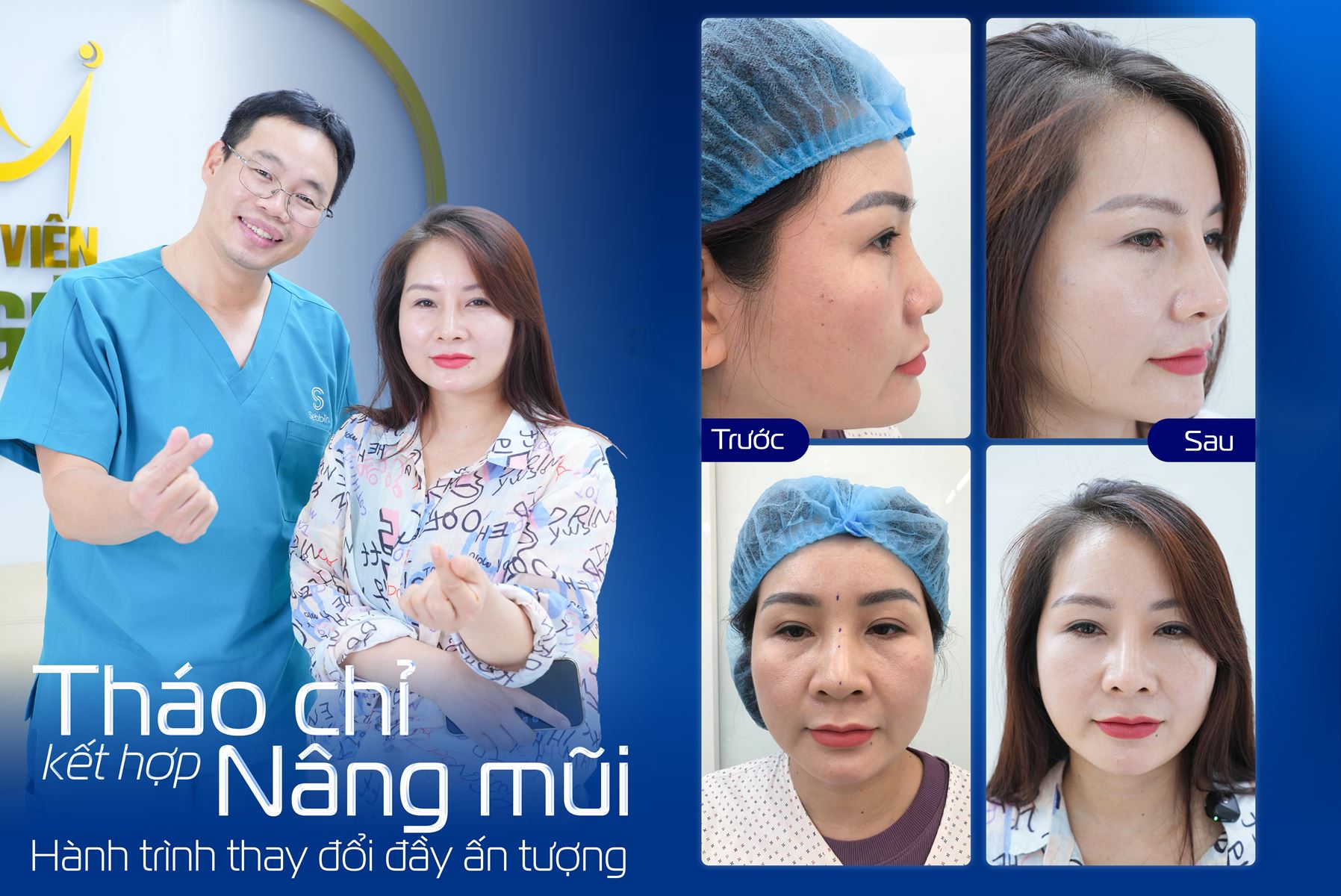 Giải cứu ca nâng mũi chỉ kết hợp filler: 1 năm nhìn lại