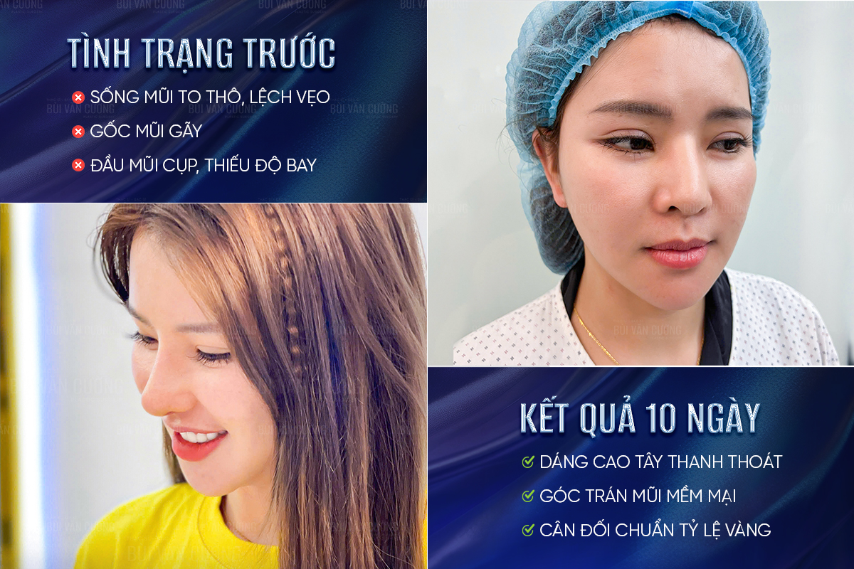 Nâng mũi cấu trúc phù hợp với những ai? Những trường hợp nên thực hiện?