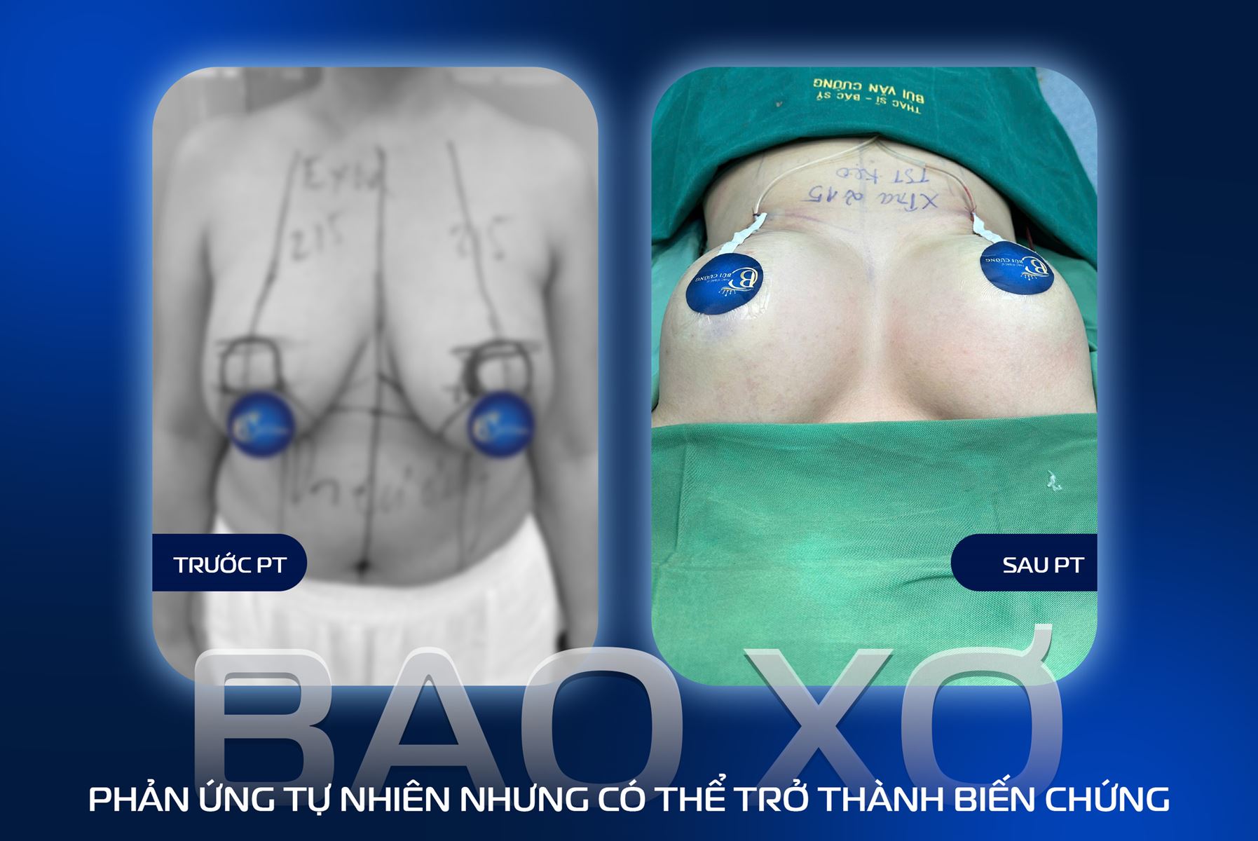 Bao xơ sau nâng ngực: Vì sao cần quan tâm đến kỹ thuật phẫu thuật?