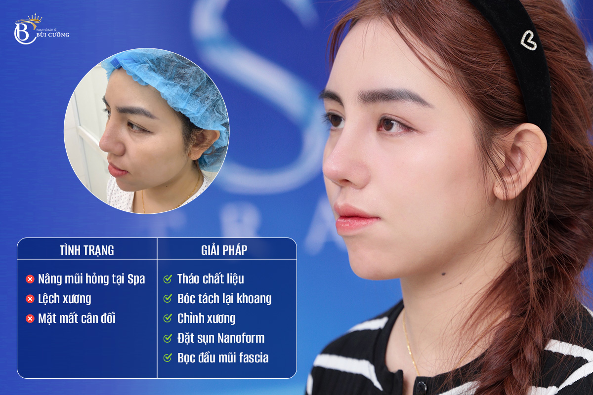 Ths.BS Bùi Văn Cường: Sửa mũi không đơn thuần là chỉnh lại hình dáng bên ngoài