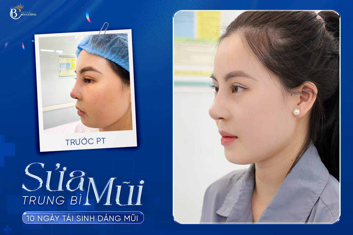 Bạn có phù hợp thực hiện sửa mũi trung bì không? Tìm hiểu ngay!