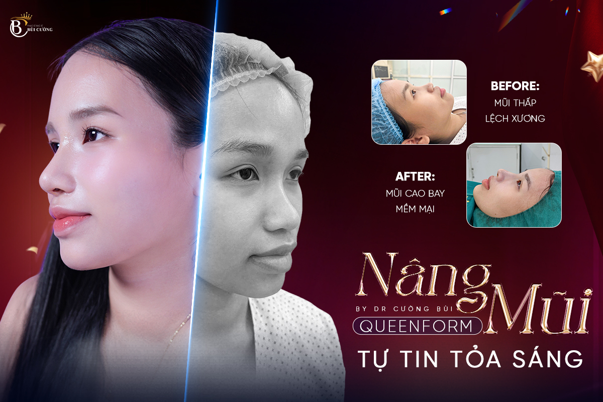 Nâng Mũi QueenForm - Cô Nàng Gen Z “Lột Xác”, Tự Tin Bước Vào Hôn Nhân