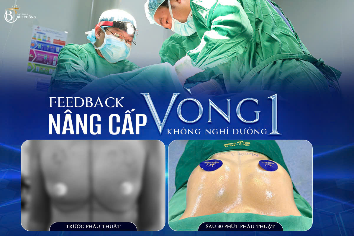Nâng Vòng 1 Không Nghỉ Dưỡng: Trải Nghiệm Thực Tế Từ Khách Hàng